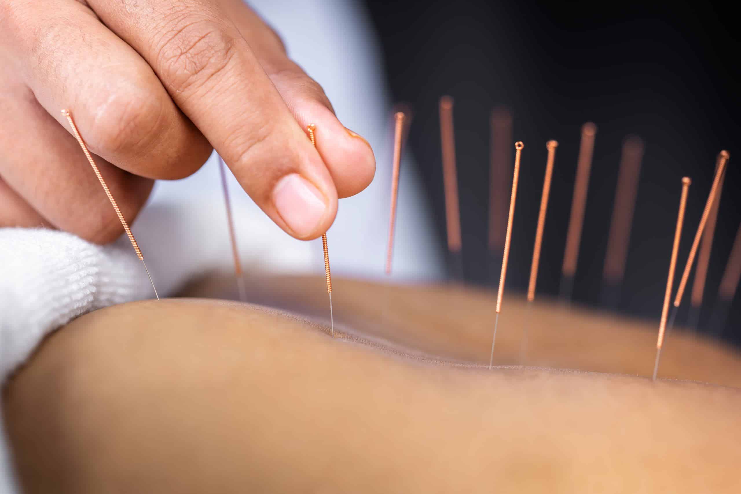 methodes-alternatives-arrêter-tabac-hyponose-acupuncture